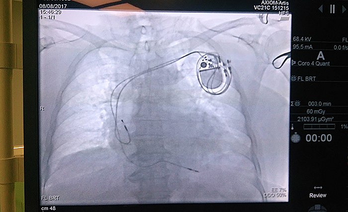 Имплантированный кардиостимулятор